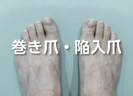巻き爪治療